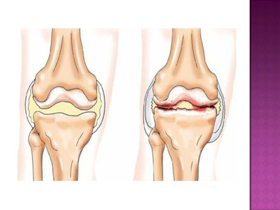 Locītava ir normāla (pa kreisi) un osteoartrīta skarta (pa labi)