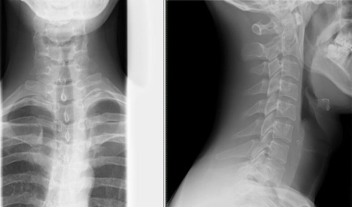 Mugurkaula rentgenogrāfija ir vienkārša un efektīva osteohondrozes diagnostikas metode