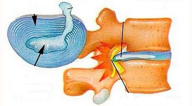 Dzemdes kakla osteohondrozes attīstības pazīmes