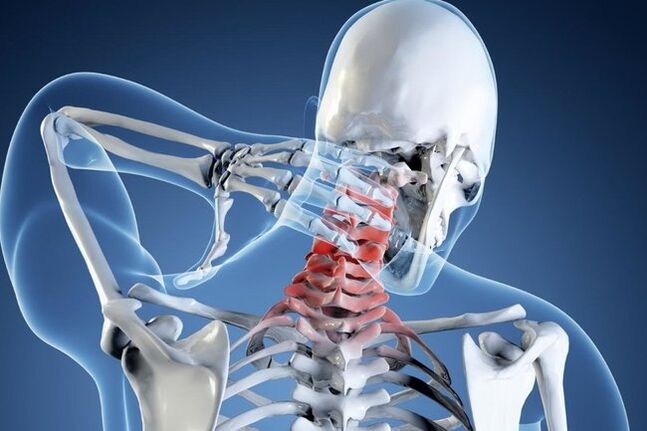mugurkaula kakla daļas osteohondroze